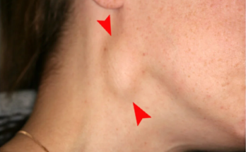 "Neck Lymph Nodes: Functions, Causes of Swelling, and When to Seek Medical Attention"