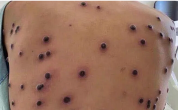 Here’s a summary of the Monkeypox Virus: 5 Important Things You Should Know About the Outbreak: